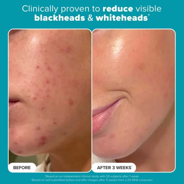 (New orignal ) Paula's Choice SKIN PERFECTING 2% BHA Liquid Salicylic Acid Exfoliant 118ml - Image 5