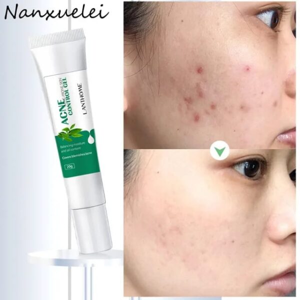 (Original)LANTHOME  Tea Tree Acne Gel - Image 2