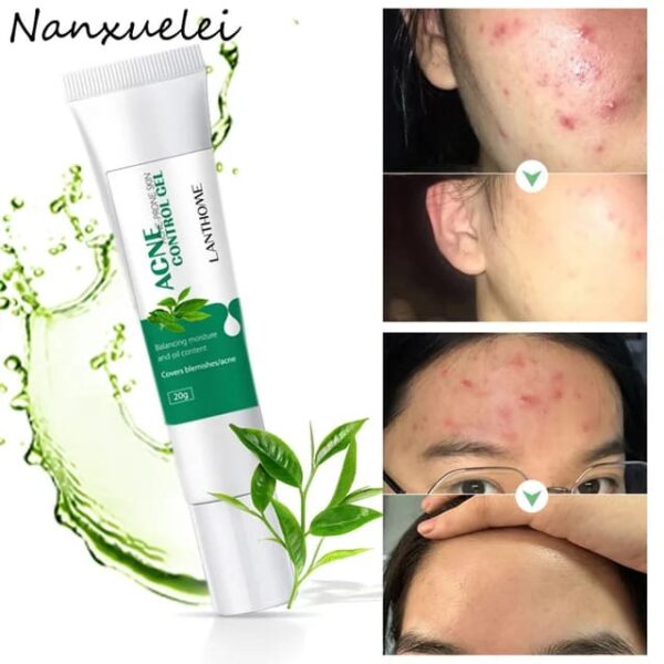 (Original)LANTHOME  Tea Tree Acne Gel - Image 3