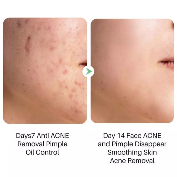 (Original)LANTHOME  Tea Tree Acne Gel - Image 7