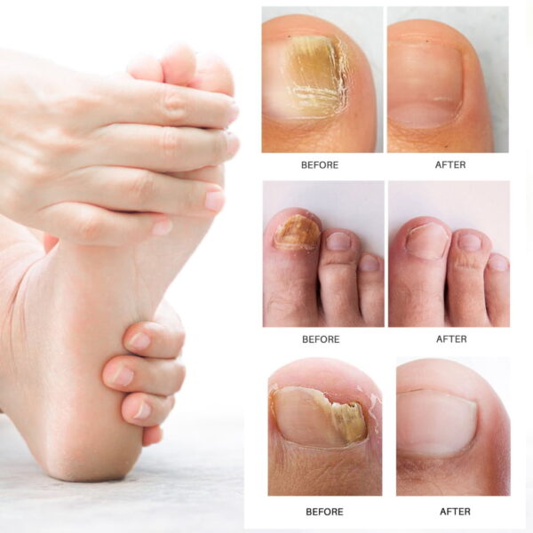 (Original)LANTHOME Nail Treatments Serums Cream Care Foot Care Nail Fungus Treatments Serums Nail Shine Nail Repair Cream - Image 6