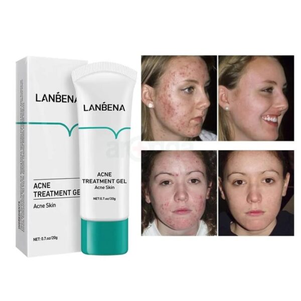 (New orignal)Lanbena Acne Treatment Gel Facial cleansing gel with tea tree extract. 20g. - Image 7