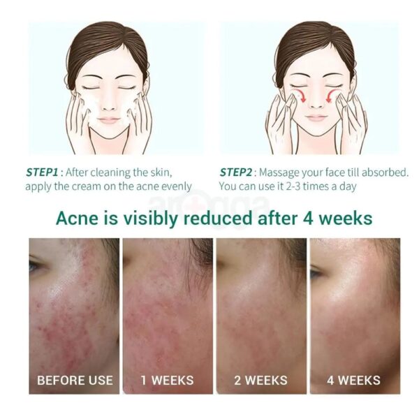 (New orignal)Lanbena Acne Treatment Gel Facial cleansing gel with tea tree extract. 20g. - Image 8